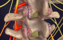 486192_sindromefacetaria 486192_sindromefacetaria