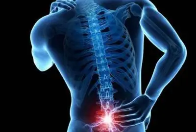 hernia-de-disco33 hernia-de-disco33